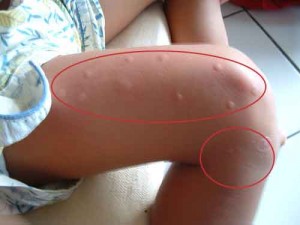 picaduras insectos en las piernas del niño